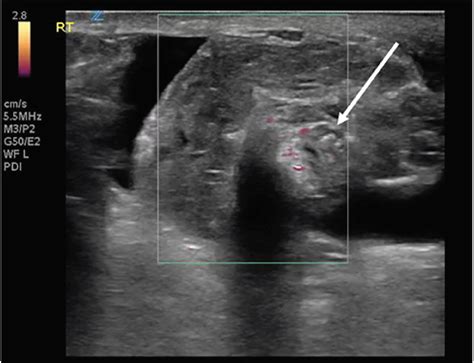 spermatic cord torsion test|spermatic cord torsion ultrasound.